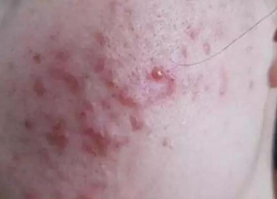 痘痘一长就不容易消灭,痘痘一长就红肿挤不出东西怎么办