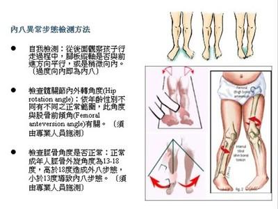如何矫正罗圈腿八字脚,16个月宝宝内八字罗圈腿