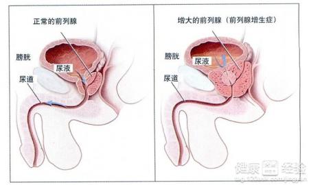 男性62岁排尿不畅夜尿增多2年,夜尿次数增加排尿不畅