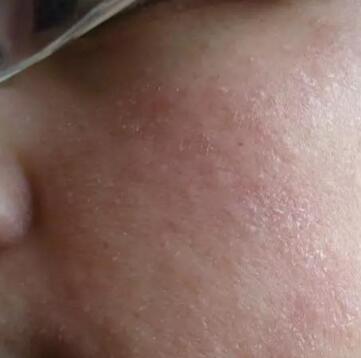 面部总是发红怎么办,面部总是泛红是怎么一回事