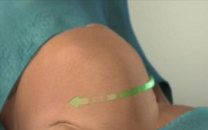 分娩时进行“剖腹产”手术全过程（附图）