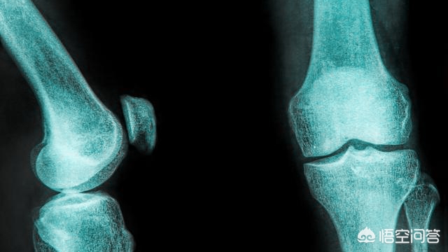 髌股关节软骨损伤能完全治愈吗,髌股骨软骨损伤