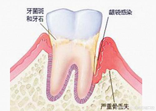 顽固牙菌斑怎么清除,5分钟内消除牙菌斑的6种有效方法