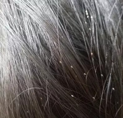 头上长虱子了,那可不是闹着玩的