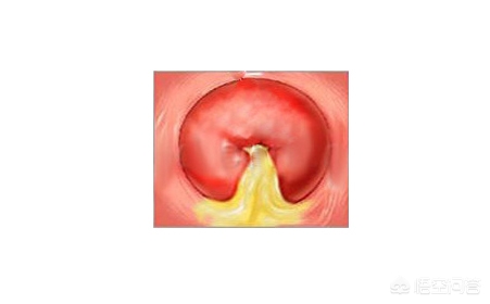 什么是宫颈炎症状,什么是宫颈炎伴鳞状上皮化生增生