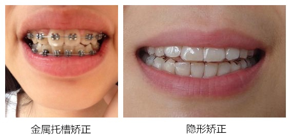 岳云鹏有牙套吗,小岳岳整牙