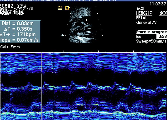 胎儿心律失常超声视频,胎儿快速型心律失常超声指标