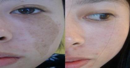 祛斑简单安全可靠又有效,如何祛斑最有效简单方法