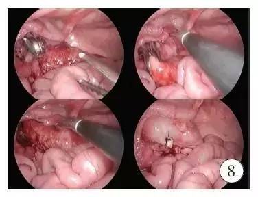 手术演示肠造口术后单切口腹腔镜辅助巨结肠根治术（Duhame1术）