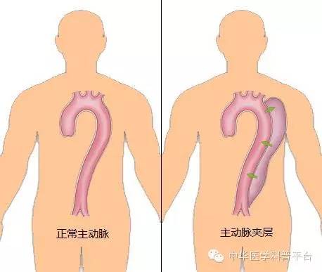 主动脉夹层什么症状,心脏主动脉夹层破裂