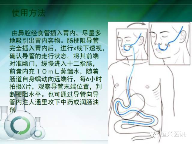 北京协和医院治疗肠梗阻的专家,恶性肠梗阻专家