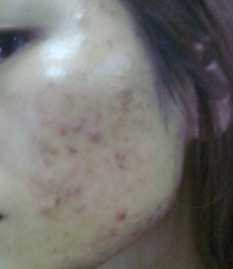 痘痘怎么快速消除医生推荐,痘痘怎么快速消除用什么方法