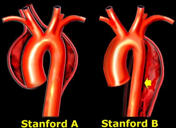 美国治疗主动脉夹层,倪海厦治疗主动脉夹层