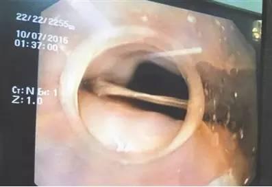 鱼刺被卡在喉咙里怎么获救,鱼刺卡喉吞饭怎么处理