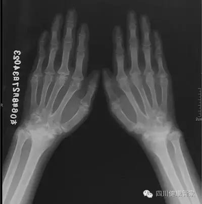 类风湿性关节炎临床典型案例分析,治疗类风湿性关节炎的最好土方法