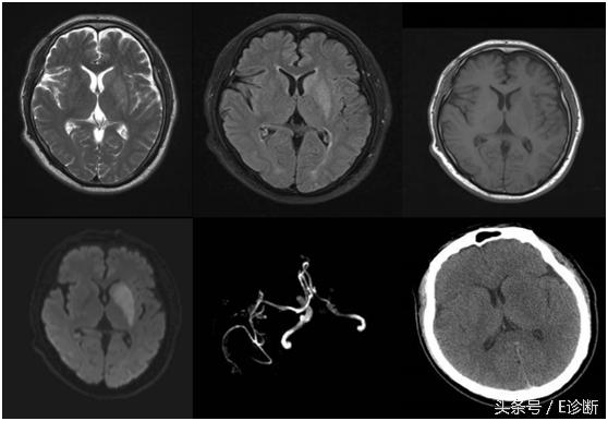 E诊断：脑梗塞影像图解