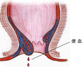 3岁多宝宝有便血怎么回事,宝宝便血三天了鲜红不痛能自愈吗