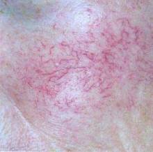 红血丝敏感肌肤怎么修复好,屏障受损敏感红血丝肌肤怎么修复