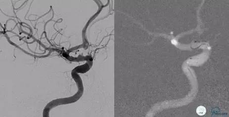 床突旁动脉瘤的血管内治疗