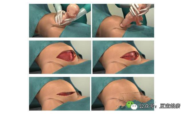 伊能静产后伤口怎么处理,伊能静产后恢复过程