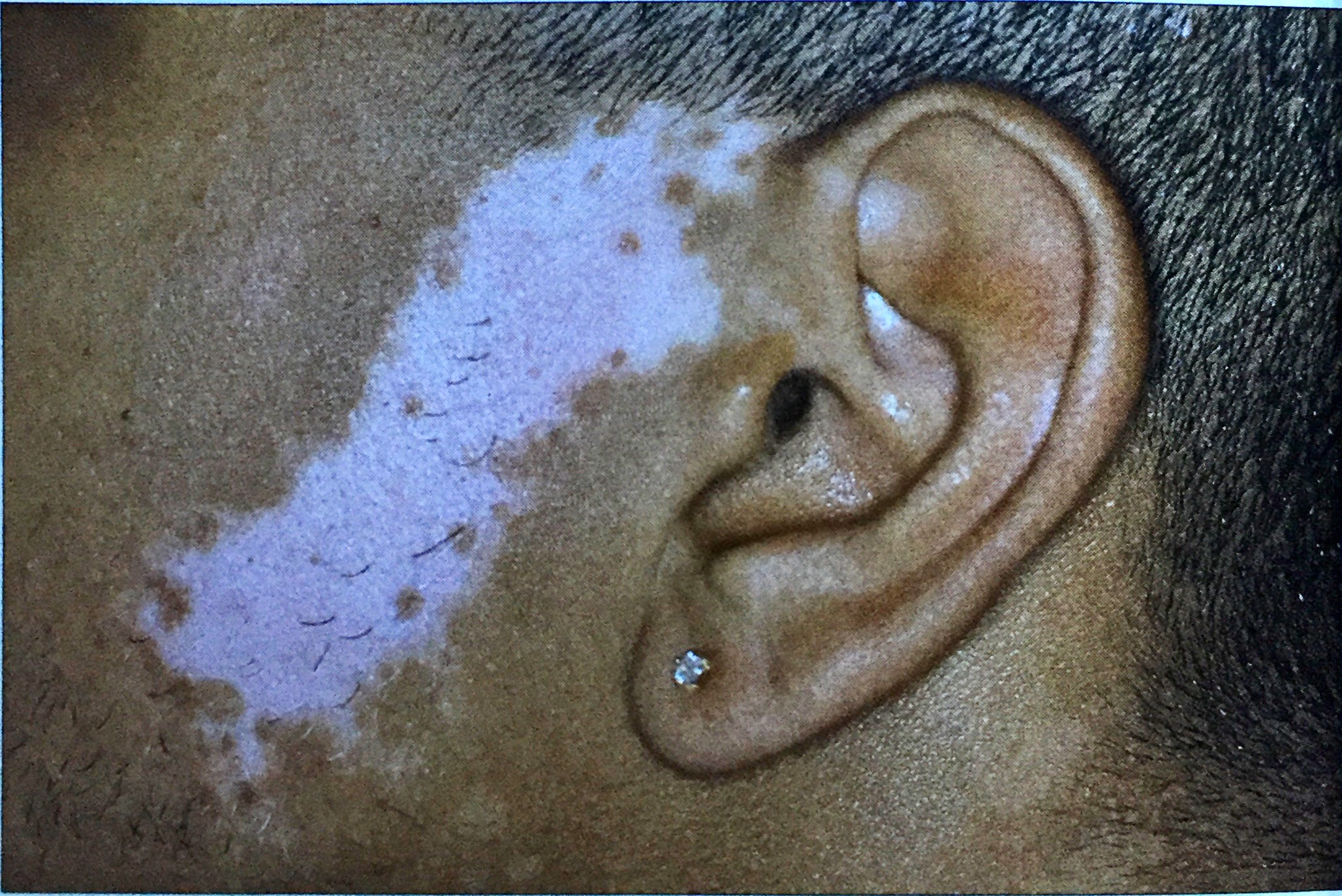 治疗白癜风遇到瓶颈期怎么办,白癜风开始发展了该怎么办