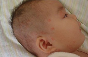 婴儿湿疹要及时不然危害是你想象不到的