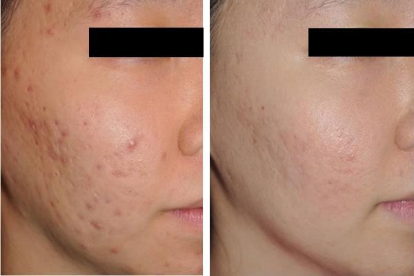 痘痘痘疤怎么消除,痘痘好了又长不断根