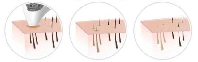 如何选择家用脱毛仪,适合嫩肤的脱毛仪