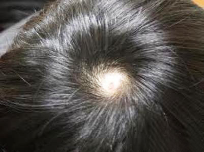 15岁斑秃中医辨证论治,21岁男生斑秃可以自愈吗