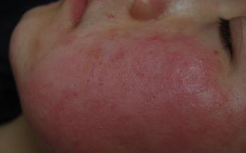 3岁宝宝吃药过敏大概多久能好,宝宝吃药过敏起红疹怎么办