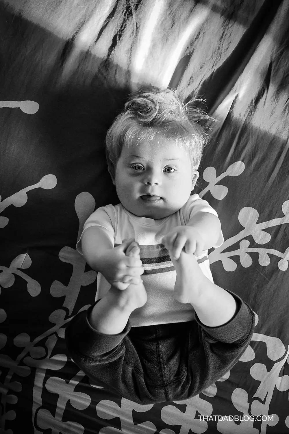 小孩患唐氏综合征,唐氏综合征比较幸运的孩子