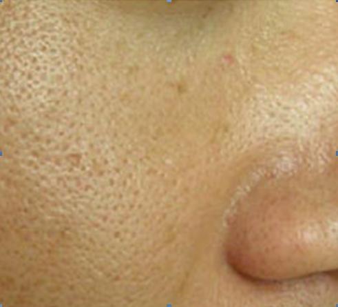 毛孔粗大黑头痘痘适合哪种护肤品,毛孔粗大黑头痘痘修复烂脸精华液