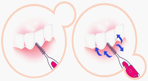 治疗牙周炎牙齿松动的偏方秘方,什么药偏方治疗牙周炎去除牙结石