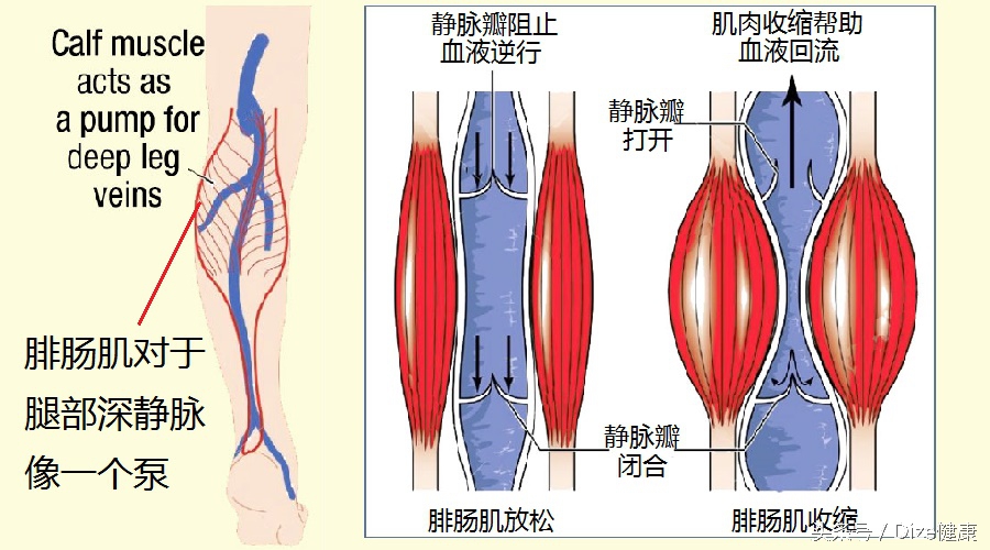 坐得久了小腿肿怎么办,静脉曲张引起的小腿肿怎么消除