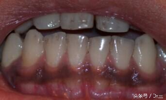 牙龈变色暗示哪里有病,牙龈变黑是什么征兆