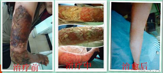 张祥英亲历：右臂三度烧伤28天治愈不植皮