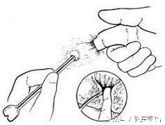 大便擦不干净有什么后果,大便擦不干净瘙痒有时擦了带血