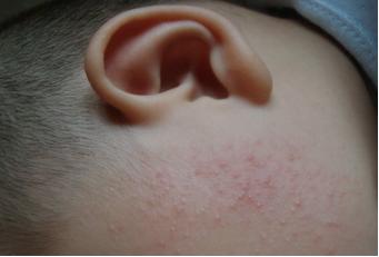 新生儿面部奶癣湿疹用什么药膏,婴儿湿疹奶癣用什么擦能好