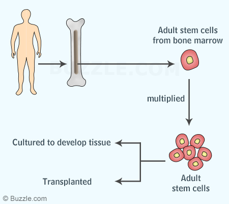 人羊膜上皮干细胞移植治疗帕金森,帕金森叠加综合征与干细胞移植