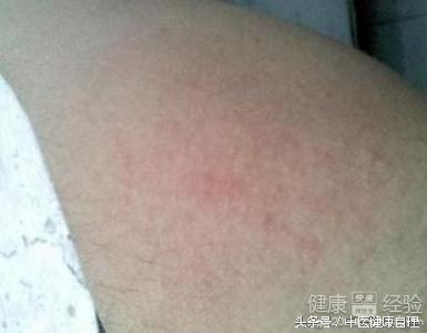 湿疹性皮炎中医辨证,小儿湿疹中医辨证