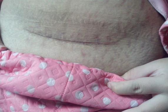 剖腹产为什么医生建议39周剖腹产,剖腹产后最常见的三个后遗症