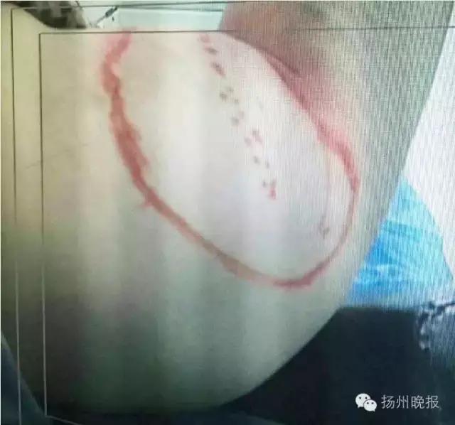 南昌一女子体内长40斤肿瘤,男子脖子处长了一个10斤重的肿瘤