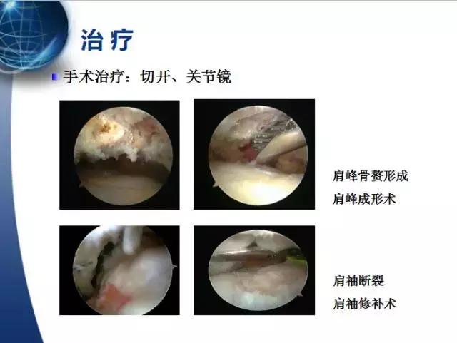 013医院,肩膀病怎么治疗最快最有效