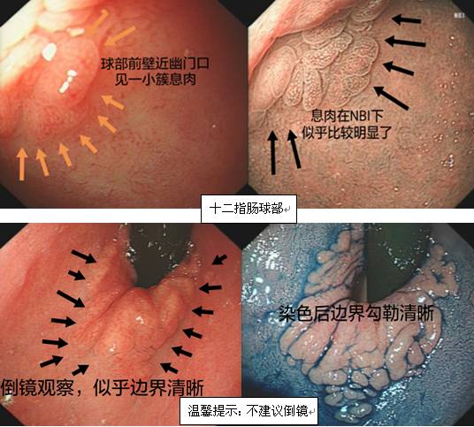 精细胃镜检查（二）——色素内镜（上）