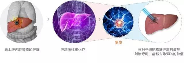 肝癌质子治疗,质子治疗对肝癌的要求