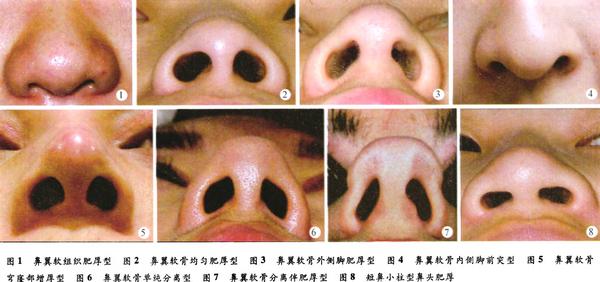 鼻头缩小整形有什么后遗症,鼻头缩小整形手术的方法
