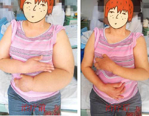 九旬老汉每天“挤奶”4斤，什么是淋巴？