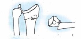 桡骨远端骨折传统石膏打法,成人桡骨远端骨折诊疗指南2023版