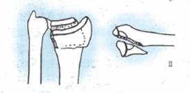 桡骨远端骨折传统石膏打法,成人桡骨远端骨折诊疗指南2023版