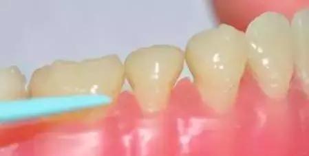 牙中间有缝怎么办,前牙有缝修复